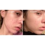 سرم ضد لک آنوا مدل نیاسینامید 10% + ترانگزامیک اسید 4% حجم 30 میلی لیتر - Image 4